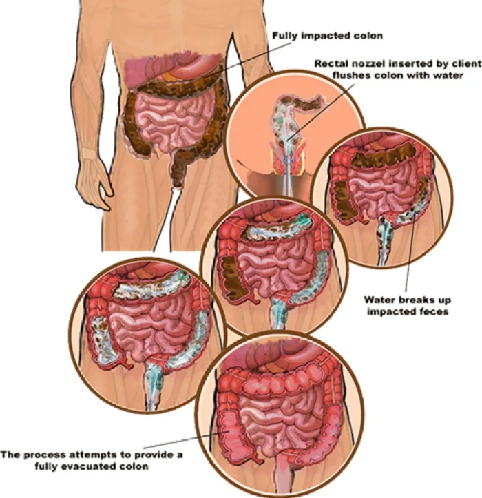 Colonic Machine 185