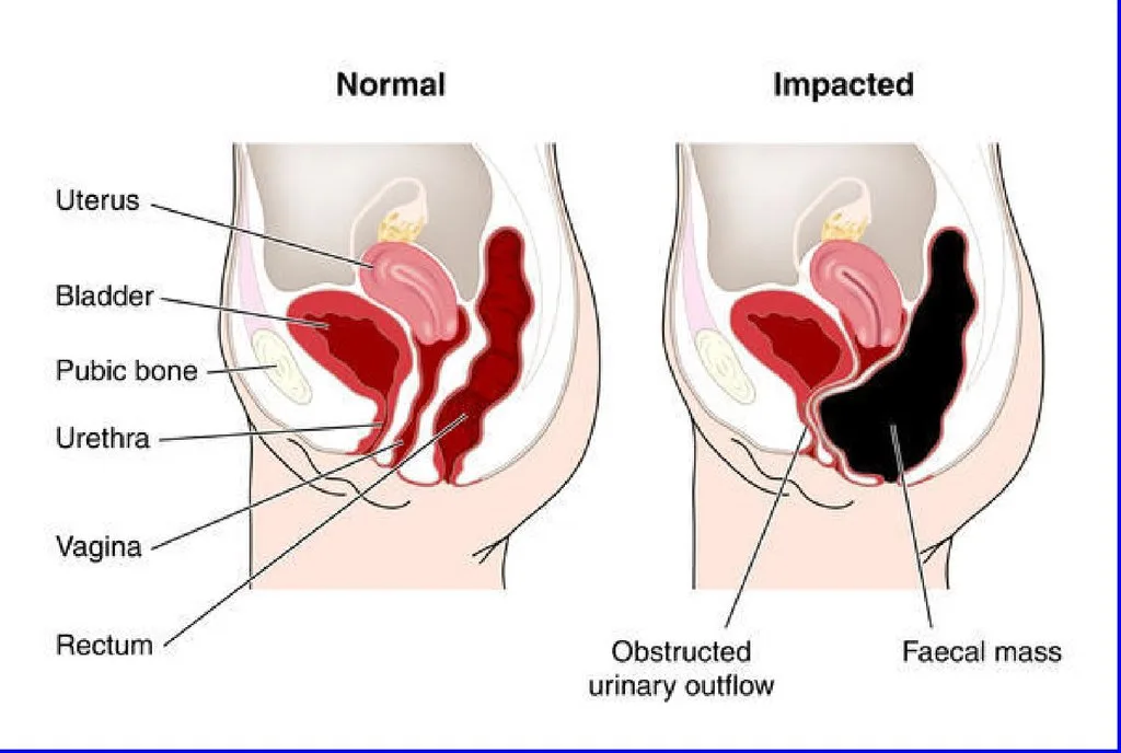 How to Get Rid of Toxic Poop?